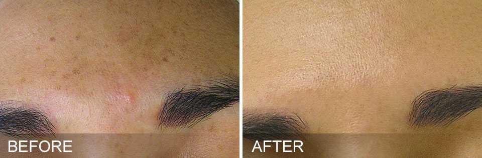 before and after of clear skin