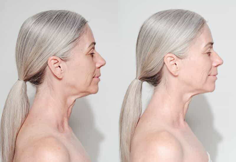 Before & After pics of the treatment