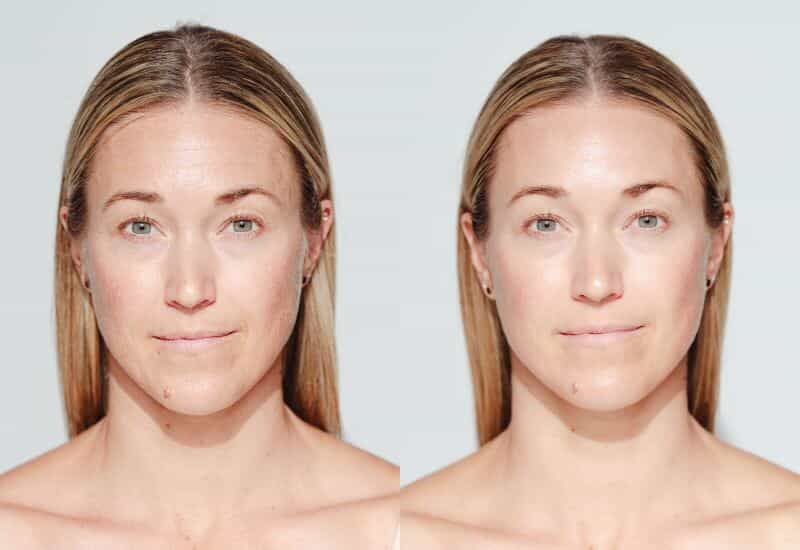 Before & After pics of the treatment